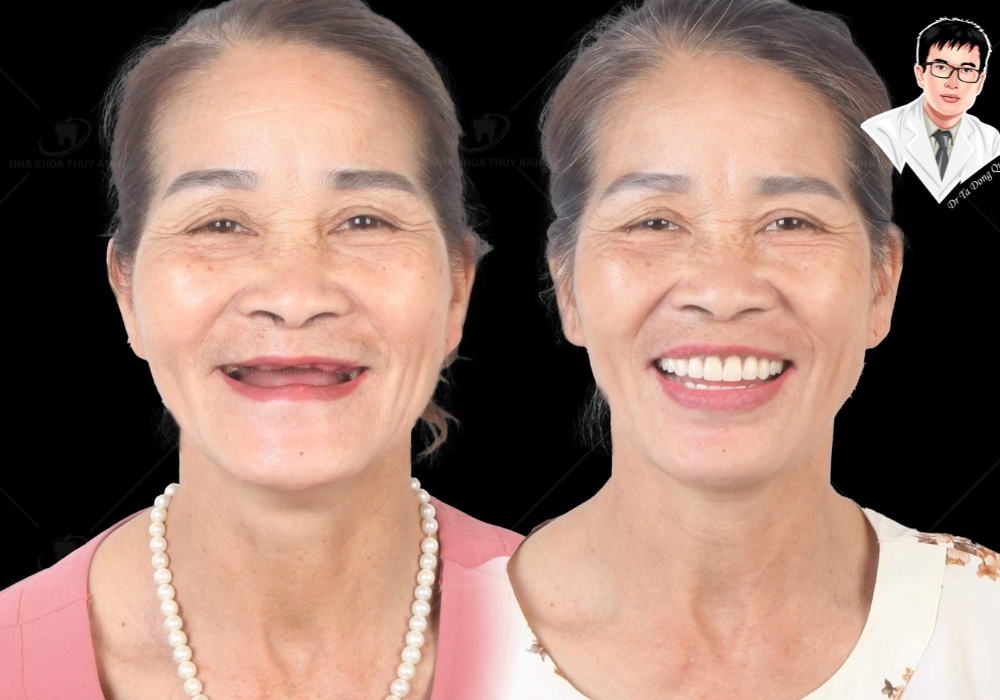 So sánh trước – sau khi cấy implant của một bệnh nhân nữ lớn tuổi, cải thiện rõ rệt cả nụ cười lẫn thần thái gương mặt.