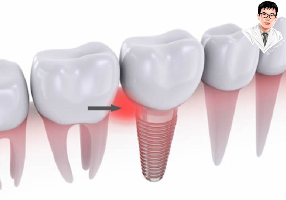 Lợi sưng sau khi trồng răng là phản ứng viêm sinh lý bình thường