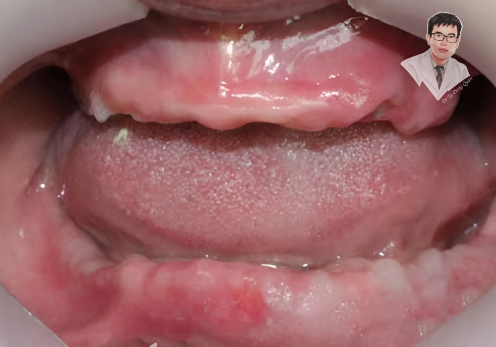 Xương hàm tiêu biến nghiêm trọng? Trồng răng Implant All On 4 là giải pháp cần thiết ngay hôm nay! Hình ảnh thực tế xương hàm đã tiêu biến – trường hợp cần điều trị bằng Implant All On 4 để phục hồi ăn nhai và ngăn tiêu xương tiếp diễn.