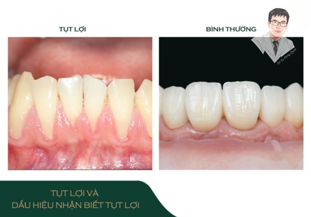 Hình ảnh so sánh giữa nướu khỏe mạnh và nướu bị tụt, giúp người xem nhận biết sự khác biệt.