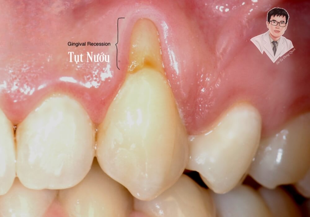 Hình ảnh cận cảnh tình trạng tụt nướu nghiêm trọng, lộ chân răng và gây ê buốt, ảnh hưởng đến sức khỏe răng miệng.