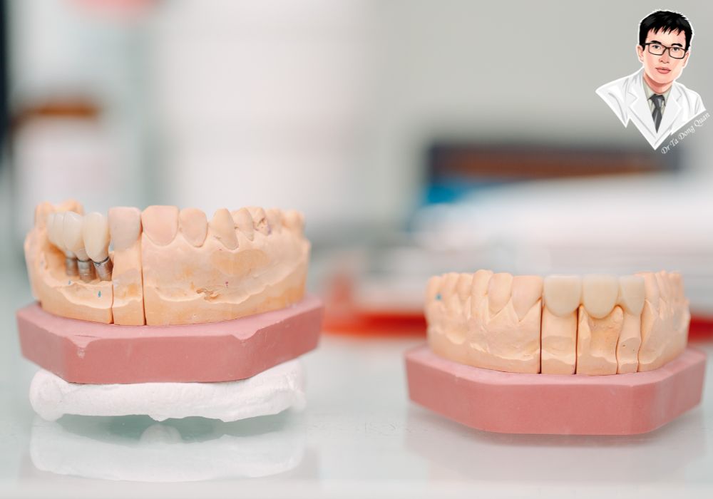 Trụ titanium chuẩn bị cấy vào xương hàm – vật liệu an toàn và bền bỉ.