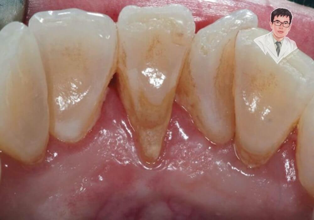Hình ảnh răng cửa bị tụt nướu nghiêm trọng, lộ rõ chân răng, gây ê buốt và mất thẩm mỹ. Đây là dấu hiệu cảnh báo bệnh nha chu cần được điều trị sớm.