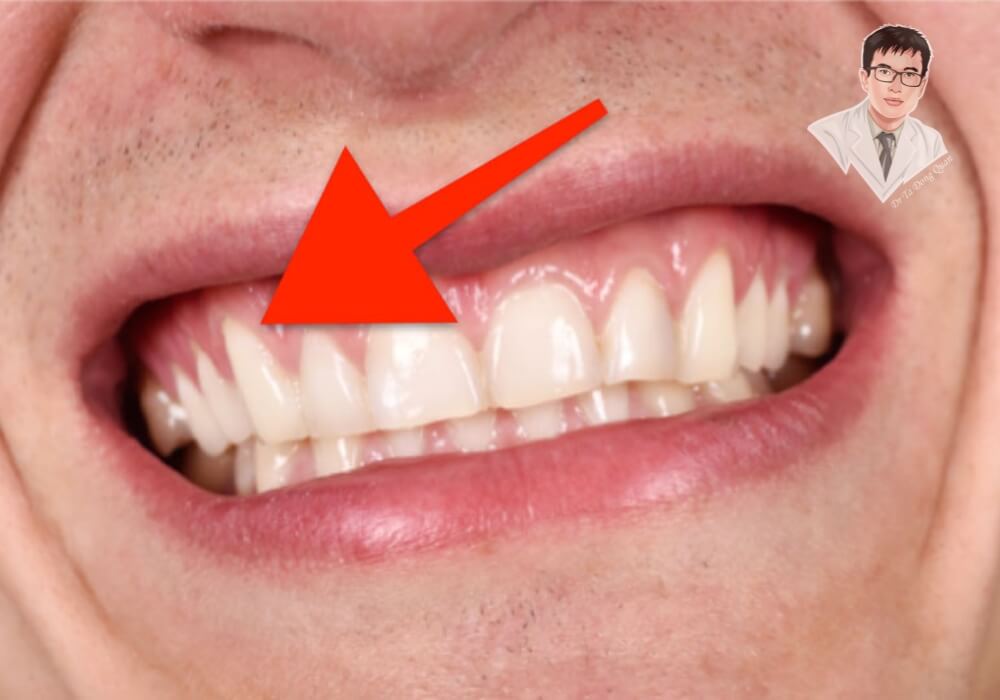  Cận cảnh một người bị tụt nướu lộ chân răng, với mũi tên đỏ chỉ vào vùng nướu bị co rút, làm lộ phần chân răng rõ rệt.