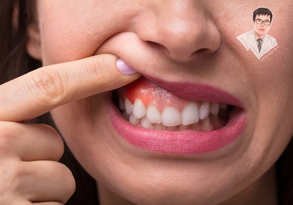 Tụt nướu răng gây ê buốt, viêm nướu? Đừng bỏ qua dấu hiệu cảnh báo nguy hiểm này! Một người phụ nữ dùng tay vạch nướu để kiểm tra tình trạng tụt nướu, nướu đỏ và có dấu hiệu viêm.