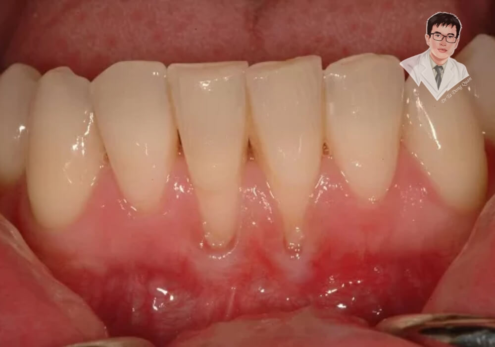 "Tụt nướu răng nặng – Nguyên nhân và cách khắc phục ngay!" Hình ảnh tụt nướu răng nghiêm trọng, lộ chân răng rõ rệt, gây mất thẩm mỹ và tăng nguy cơ ê buốt, sâu răng.
