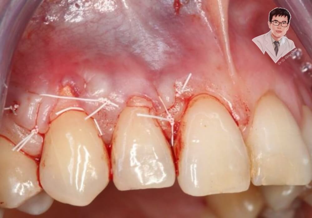 "Tụt nướu răng cửa - dấu hiệu nguy hiểm bạn cần biết!" Hình ảnh cận cảnh tình trạng tụt nướu răng cửa, vùng nướu bị viêm, sưng đỏ, chân răng lộ rõ, có chỉ khâu sau khi điều trị nha khoa thẩm mỹ hoặc nha chu.