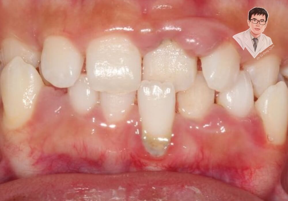 "Cảnh báo: Tụt nướu răng cửa nghiêm trọng ảnh hưởng đến thẩm mỹ và sức khỏe!" Hình ảnh thực tế cho thấy rõ tình trạng tụt nướu nghiêm trọng ở răng cửa hàm dưới, chân răng dài và bị lộ hoàn toàn, nướu đỏ, có dấu hiệu viêm nhiễm rõ ràng.