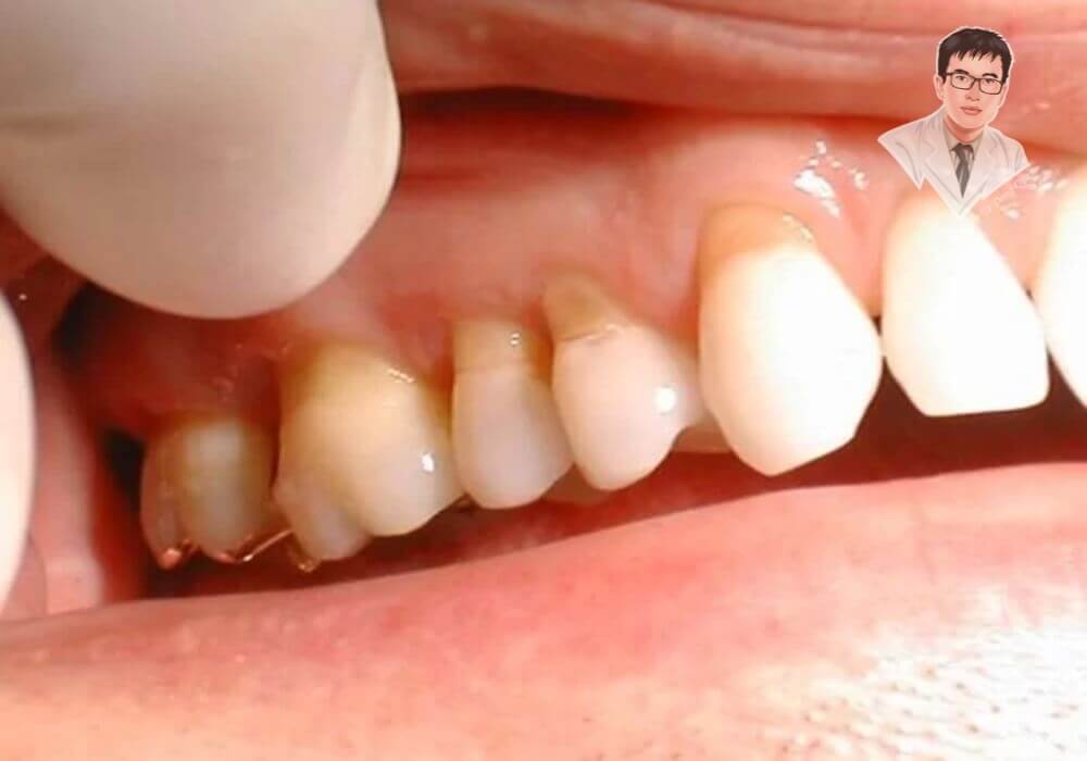  Răng hàm trên bị tụt nướu, lộ chân răng rõ rệt do viêm nha chu. Nếu không được điều trị kịp thời, có thể dẫn đến rụng răng vĩnh viễn.