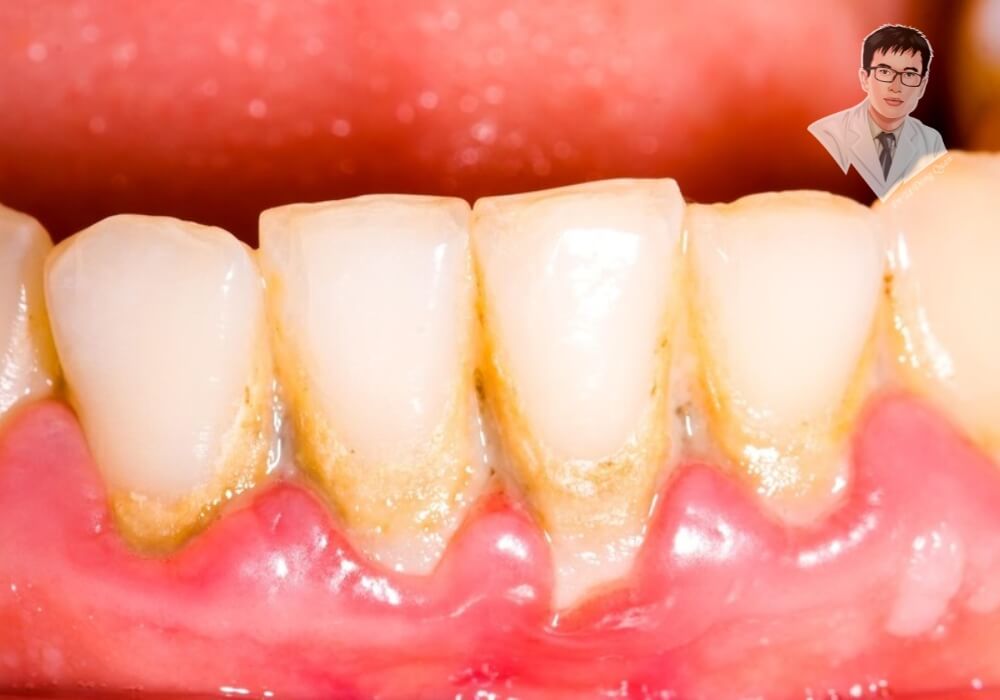 Hình ảnh thực tế về tình trạng tụt nướu răng với phần chân răng lộ rõ, dễ gây ê buốt và viêm nướu. Tình trạng này thường xảy ra do chải răng sai cách hoặc bệnh nha chu.