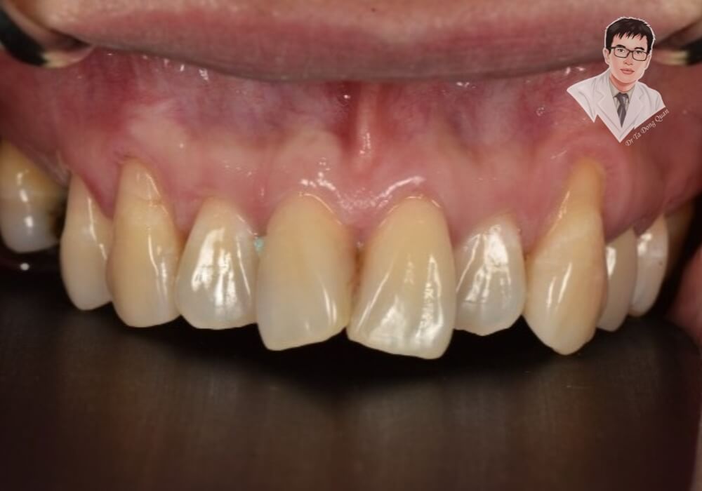 Hình ảnh thực tế của tình trạng tụt nướu răng nghiêm trọng, lộ rõ chân răng và gây mất thẩm mỹ. Đây là hậu quả của viêm nha chu kéo dài và chăm sóc răng miệng không đúng cách.