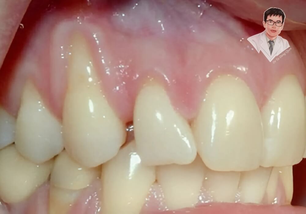 Hình ảnh mô tả tình trạng tụt nướu răng nghiêm trọng với chân răng lộ rõ, làm tăng nguy cơ viêm nha chu và mất răng. Nếu không điều trị sớm, tình trạng này có thể gây tiêu xương ổ răng.