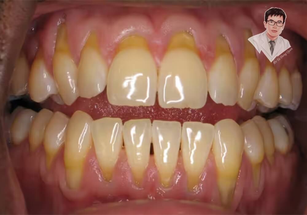 Cận cảnh hàm răng bị tụt nướu nghiêm trọng, lộ rõ chân răng, răng ố vàng và có nhiều cao răng tích tụ.