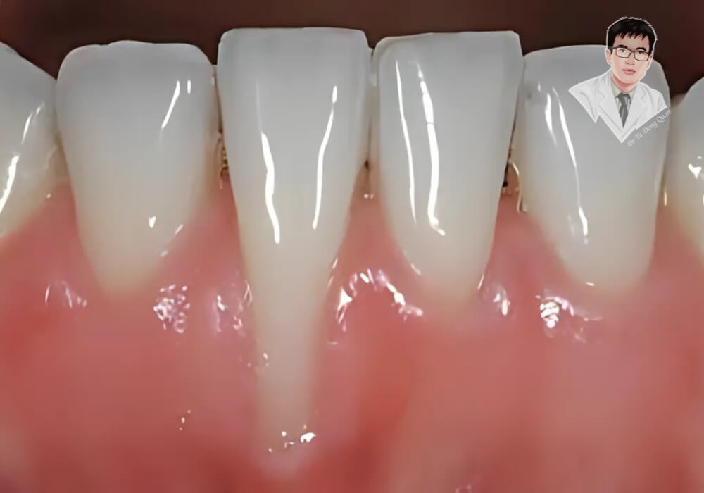 "Tụt nướu răng có chữa được không? Xem ngay giải pháp!" Hình ảnh viêm nướu gây chảy máu, sưng đỏ và dẫn đến tình trạng tụt nướu răng nếu không điều trị kịp thời.