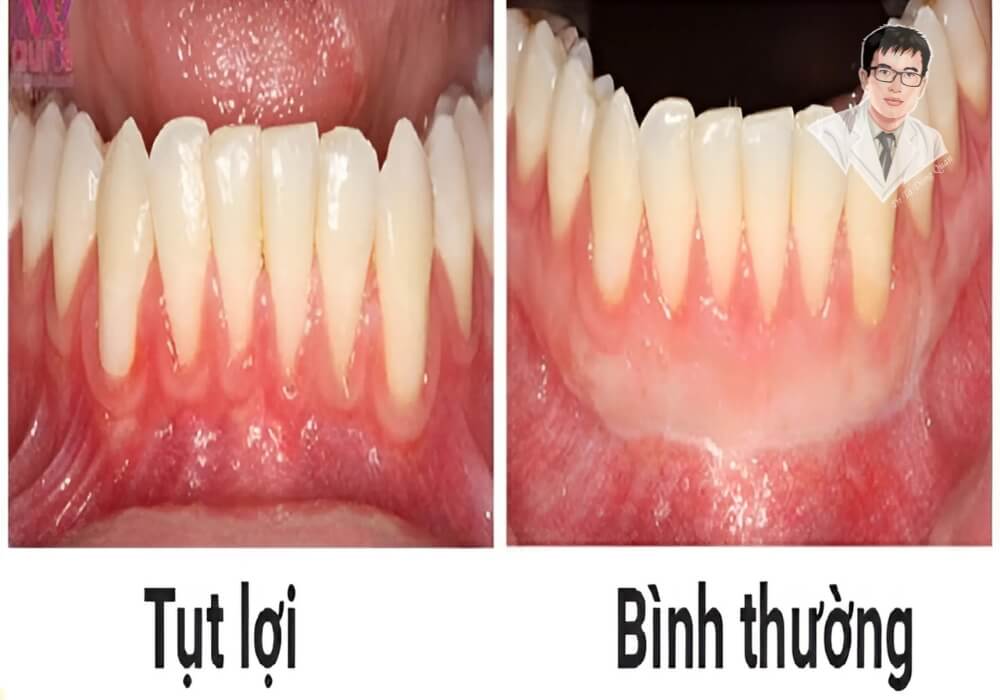So sánh trực quan giữa hình ảnh hàm răng bị tụt lợi và hàm răng có lợi khỏe mạnh bình thường, cho thấy rõ ràng phần chân răng lộ ra do tụt nướu.