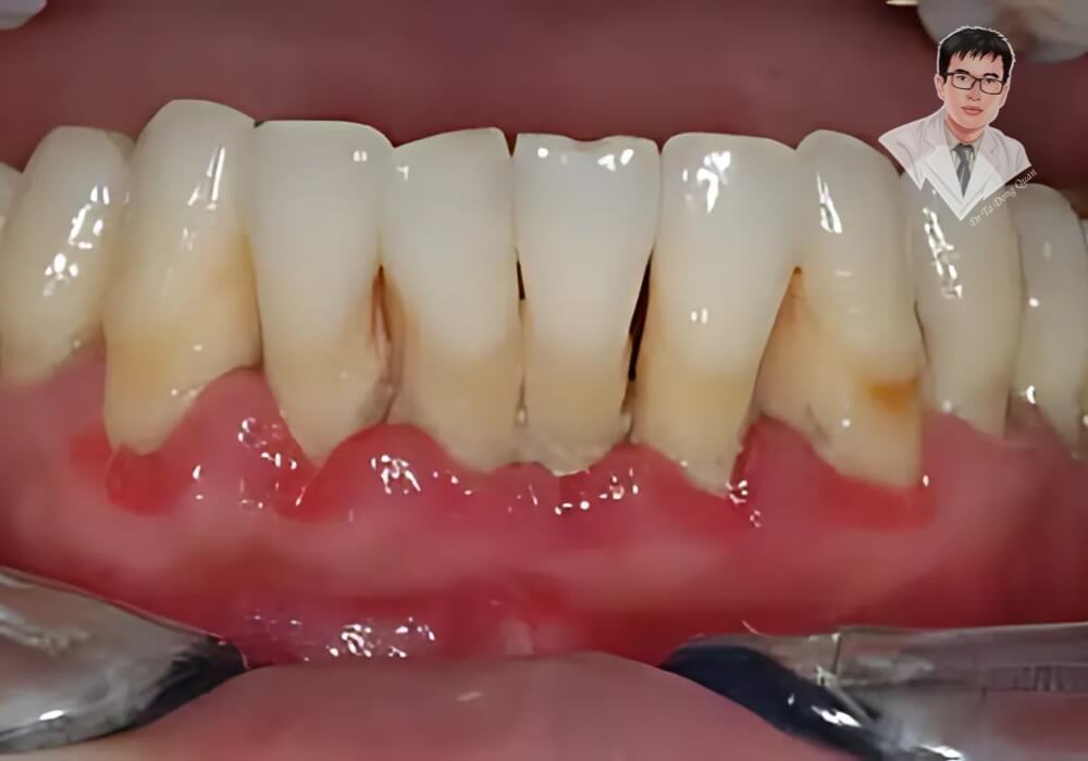 Hình ảnh nướu sưng đỏ, viêm nhiễm, chảy máu – dấu hiệu của viêm nha chu dẫn đến tụt nướu.
