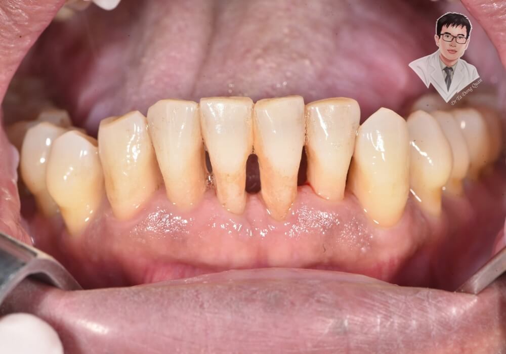 Viêm nướu – Nguyên nhân phổ biến gây tụt nướu răng! Viêm nướu nghiêm trọng với dấu hiệu sưng đỏ, chảy máu và mô nướu bị phá hủy. Đây là một trong những nguyên nhân hàng đầu dẫn đến tụt nướu nếu không được điều trị kịp thời.