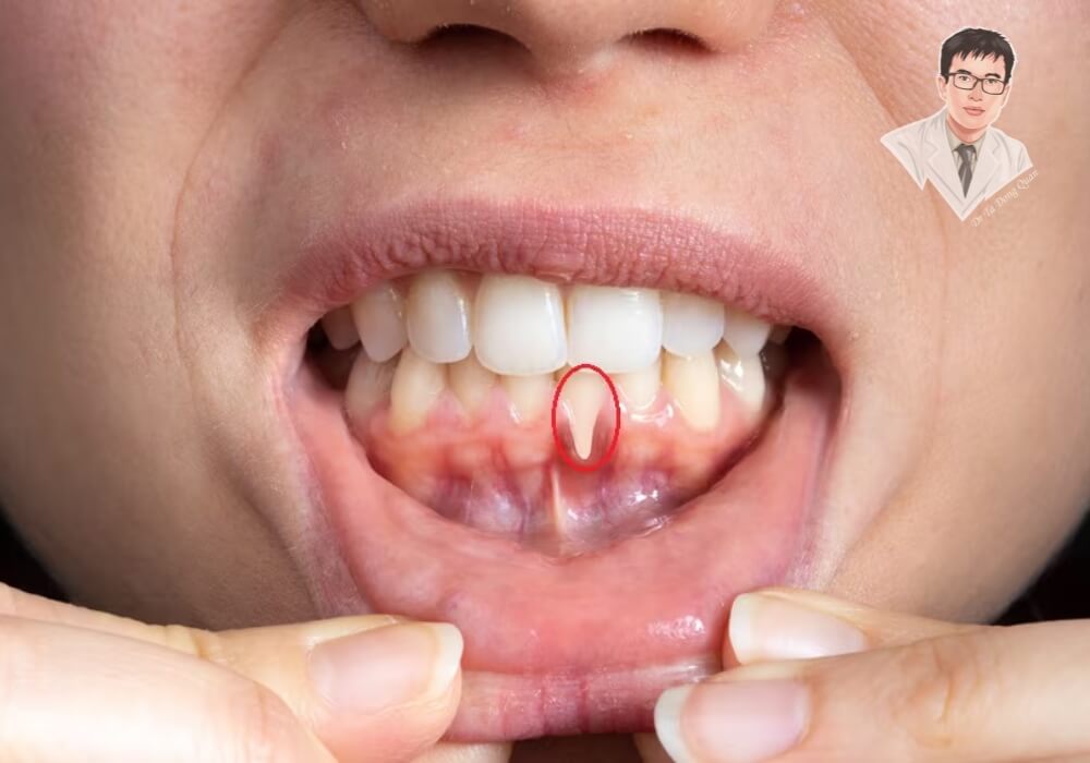 Một người bị chảy máu chân răng do viêm nướu, nướu sưng đỏ và có dấu hiệu tụt lợi rõ rệt.