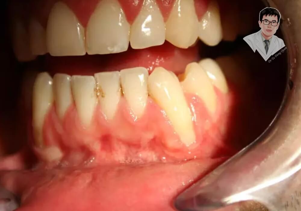 Phẫu thuật ghép nướu – Giải pháp hiệu quả giúp phục hồi nướu răng! Hình ảnh sau khi phẫu thuật ghép nướu, một phương pháp nha khoa giúp khắc phục tình trạng tụt nướu nghiêm trọng. Phương pháp này giúp bảo vệ chân răng và cải thiện thẩm mỹ nướu.