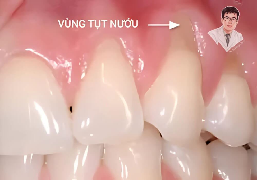 Vùng tụt nướu răng trên răng cửa, khiến chân răng lộ ra rõ rệt. Hình ảnh minh họa mức độ tụt nướu có thể gây ê buốt và ảnh hưởng đến chức năng ăn nhai.